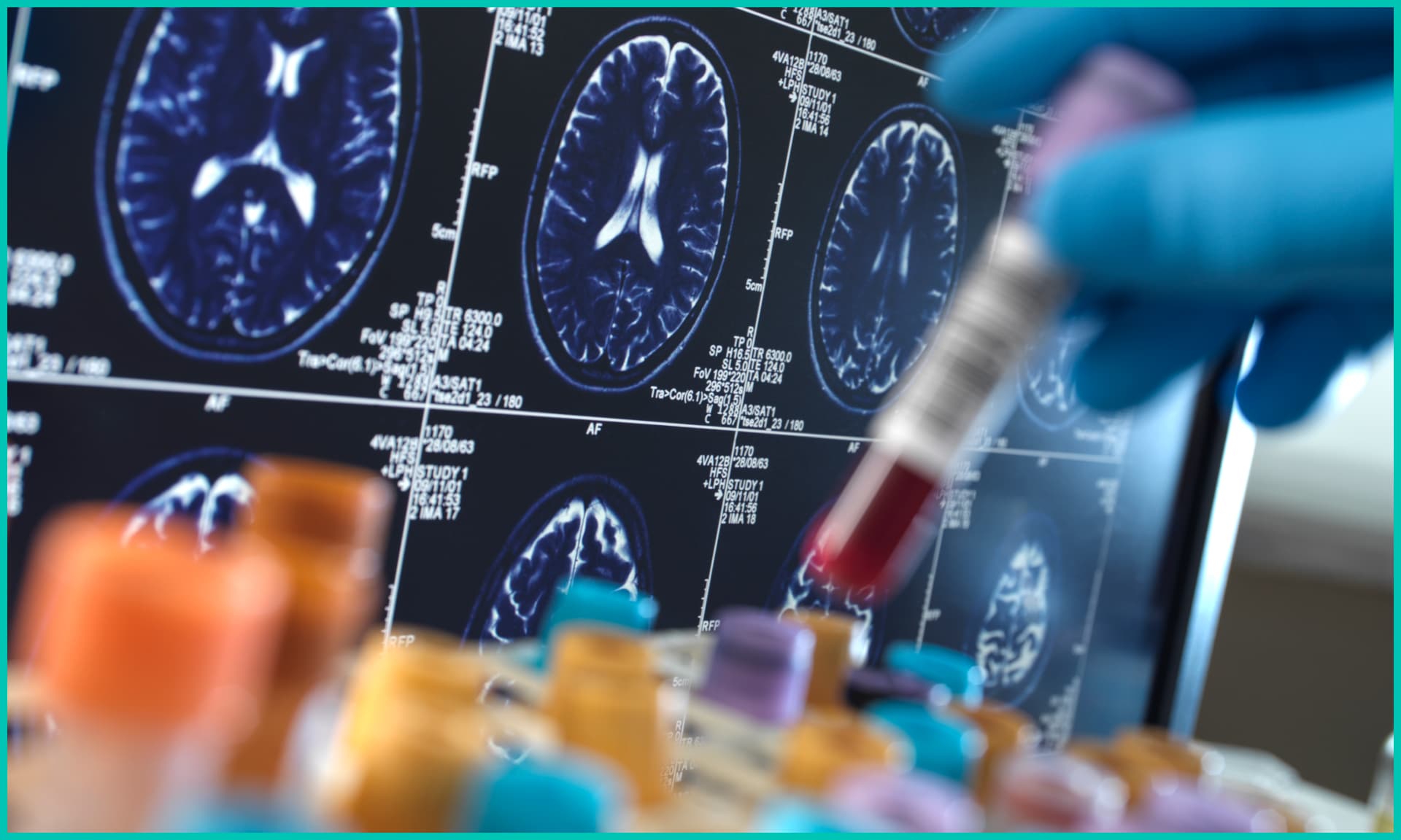 United Kingdom, High Wycombe, Alzheimer's and Dementia Research, Scientist holding a blood sample during a clinical trial with a MRI on screen 
