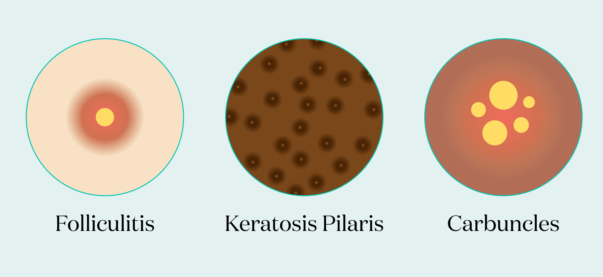 Illustrations of folliculitis, keratosis pilaris, and carbuncles