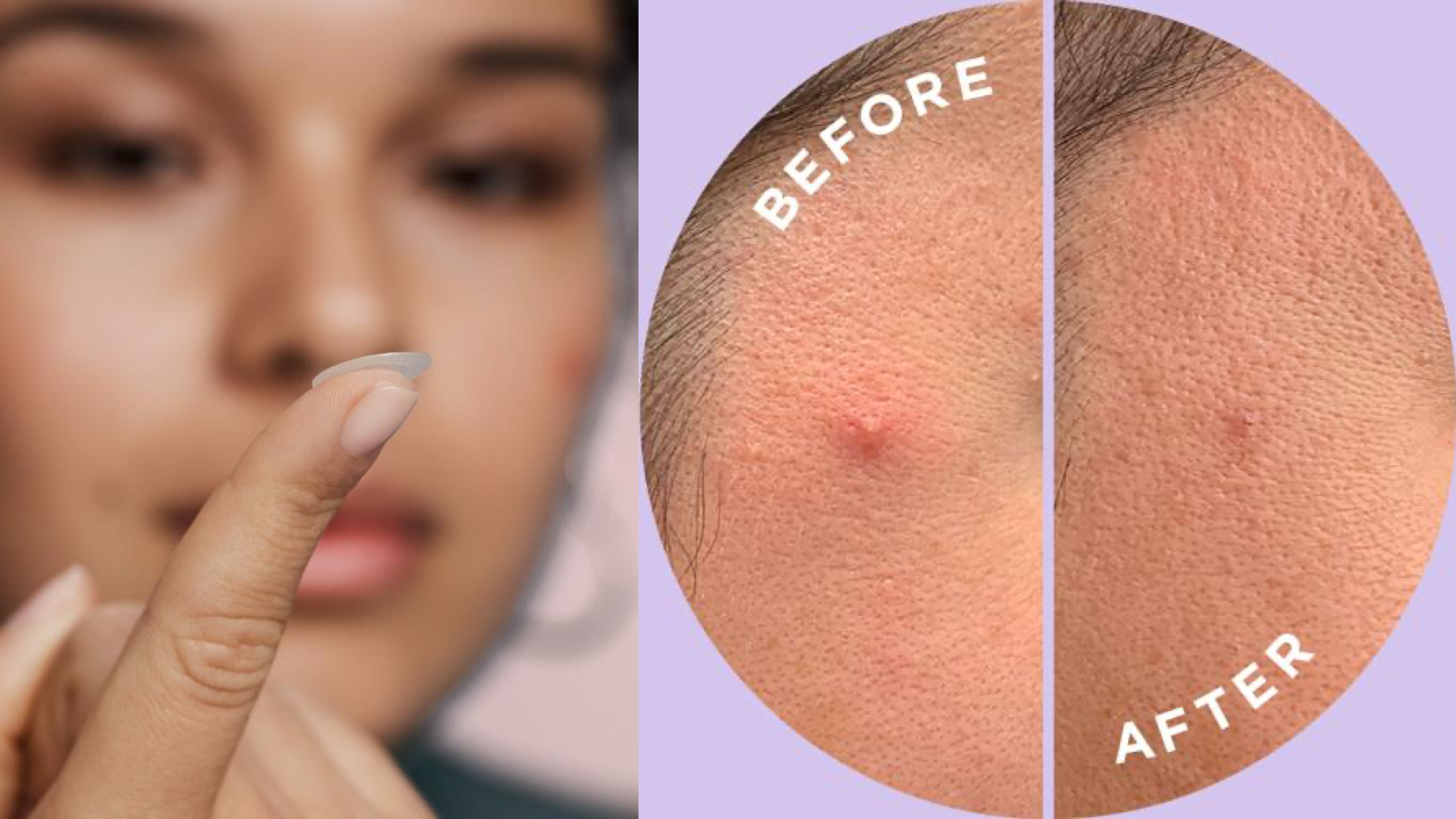 pimple patches to help heal breakouts